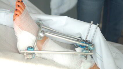 Gebrochenes Bein in Schienen