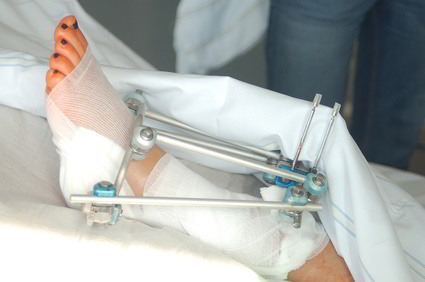 Gebrochenes Bein in Schienen